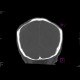 Foramina parietalia, skull fissure: CT - Computed tomography